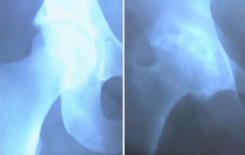 زوزه آرتروز مفصل زانو